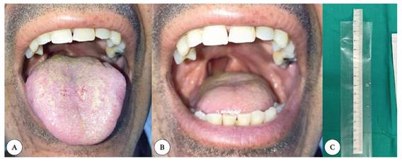 Control evolutivo posterior a las 5 sesiones de laserterapia: A) mejor�a de la lengua saburral; B) remisi�n de las lesiones ulceradas y mejoras cl�nicas de la coloraci�n de la cavidad oral al aumentar la salivaci�n; C) resultado de la sialometr�a 3,5 cm.
