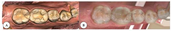 Comparaci�n de la precisi�n de los dos IOS: A) Primescan Dentsply Sirona� muestra mayor precisi�n; B) Virtuo Vivo Straumann�.