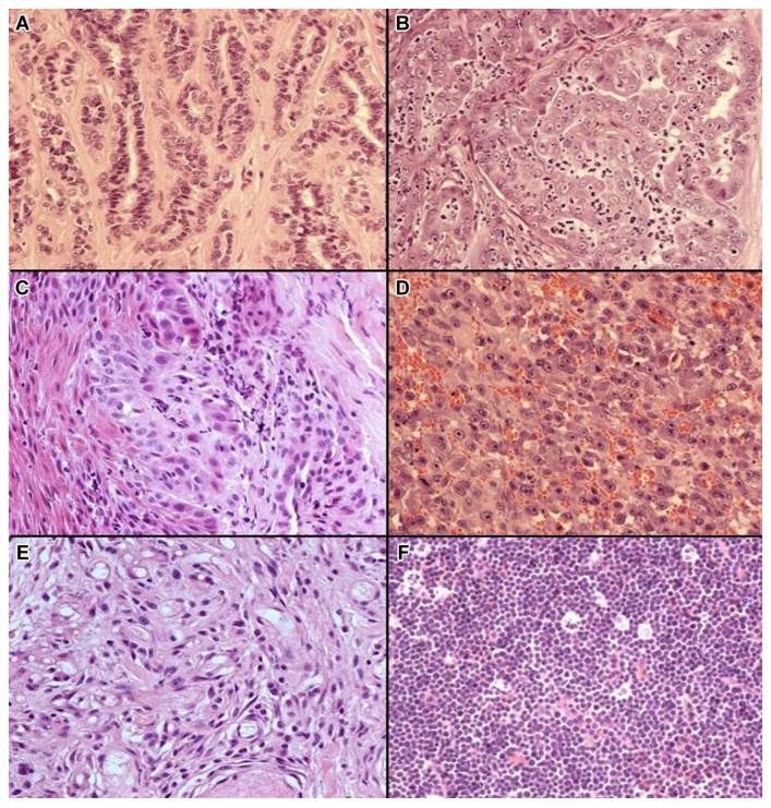 Histopathological features of the most frequently observed neoplasms. A) Mammary adenoma. Regular cords lined by one or two layers of epithelial cells and separated by a fine fibrovascular stroma. Neoplastic cells are cuboidal with poor cytoplasm and minimal atypia. B) Tubular carcinoma. Tubules lined by cuboidal epithelium with large, vesicular nuclei with a prominent nucleolus. There is a discrete intratubular neutrophilic infiltrate. C) Squamous cell carcinoma. Nest of cells with abundant eosinophilic cytoplasm with distinct borders and large vesicular nuclei with a single prominent nucleolus. These cells are immersed in desmoplastic tissue. D) Hemangiosarcoma. Polygonal cells surrounding discrete vascular channels, showing prominent nucleoli and numerous mitoses. E) Soft tissue sarcoma. Spindle-shaped tumor cells, with moderate eosinophilic cytoplasm, poorly defined; the nuclei are oval, with granular chromatin and prominent nucleoli. F) Mediastinal lymphoma. Monomorphic neoplastic lymphoid cells arranged in a solid mantle, supported by a scarce fibrovascular stroma. The cells have scarce cytoplasm, oval nuclei with finely granular chromatin, evident nucleoli, and frequent atypical mitoses. There are multifocal areas of necrosis.