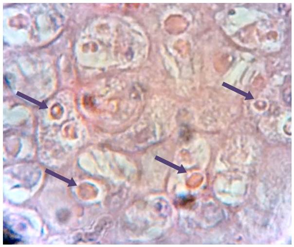 A hematoxylin and eosin-stained slide of a Chorioallantoic membrane from a chicken embryo infected with the Turkeypoxvirus. Yellow arrows show multiple intracytoplasmic inclusion bodies. 40×.