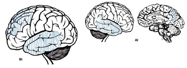 Cortex related to lexical access before (BI) and after an intervention (AI).