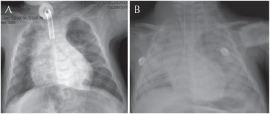 A) Estado post traqueostomía con datos radiológicos de atrapamiento aéreo;
patrón bronquítico apical e intersticial difuso característicos de la displasia
broncopulmonar. B) Consolidación basal y parahiliar derecha
compatible con neumonía comunitaria que evoluciona a sepsis y síndrome de
dificultad respiratoria.