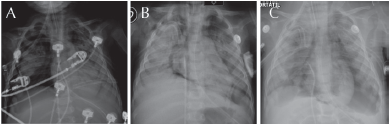 A) Neumotórax bilateral y
recurrente secundario al volu-barotrauma y sepsis
pulmonar subyacente. B) Persistencia de fuga aérea con neumomediastino
y tamponamiento cardíaco clínico e hiperinsuflación pulmón izquierdo. C) Sobredistensión pulmonar bilateral sin datos de fuga aérea con enfisema
intersticial persistente previo al fallecimiento por SDRA y sepsis