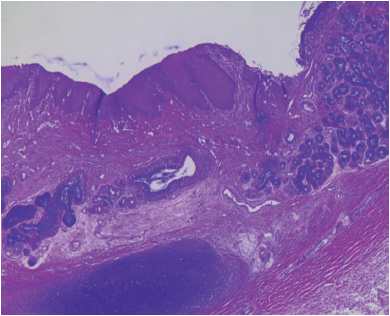 Transformación
a epitelio plano estratificado del epitelio respiratorio.