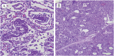 A) Alveolos con material eosinófilo denso en su luz. B) Pérdida de
luces bronquiales y bronquiolares.
