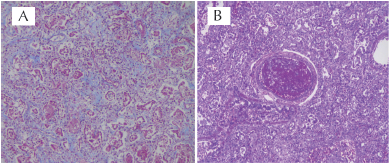 A) Tinción de Masson
que muestra la fibrosis. B) Trombo en vaso de mediano calibre.