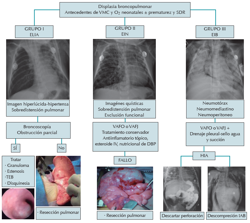 Abordaje
de las secuelas enfisematosas intersticiales en pacientes con displasia
broncopulmonar.
