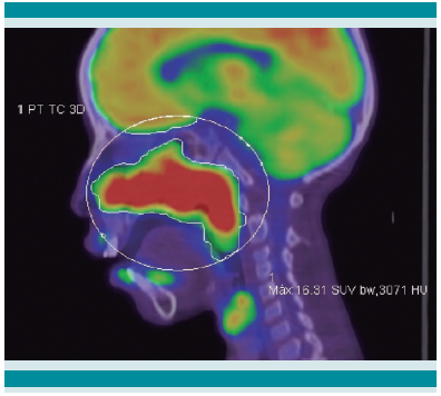 Tomografía
de emisión
de positrones con flúor 18, unido a fluordeoxiglucosa, en combinación con tomografía simple; proyección sagital: tumor en región derecha de la cara que
involucra tejidos blandos y
hueso desde la cavidad
nasal derecha hasta arriba de la raíz de premolar y
canino superiores derechos y lateralmente hacia hueso cigomático; con hipermetabolismo
importante (SUVmax de 16.3).