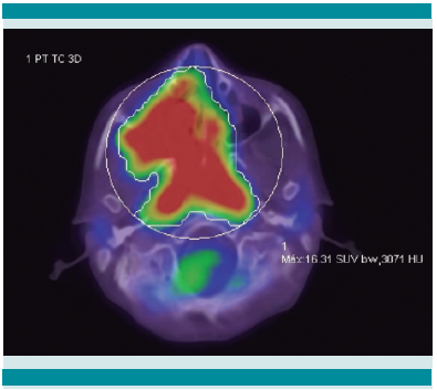 Tomografía
de emisión
de positrones con flúor
18, unido a fluordeoxiglucosa, en combinación con tomografía simple; plano axial: extensión antero-posterior del tumor limitada a regiones mencionadas en las figuras anteriores, SUVmax de 16.3.