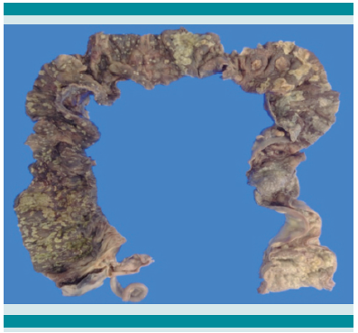 Colon con membranas blanco-amarillentas en la superficie mucosa