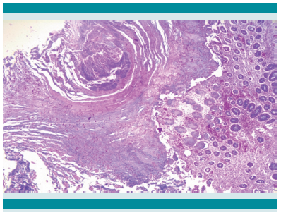 Mucosa de colon con necrosis focal y membranas en su superficie con bacterias Gram negativas