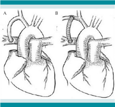 Fístula de
Blalock/Taussig. A) Clásica y B)Modificada.