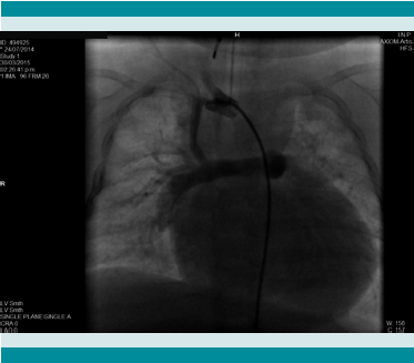 Visualización durante el cateterismo cardíaco
de la fístula de Blalock/Taussig modificada permeable. 

 