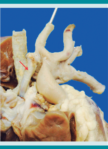 La fístula de
Blalock-Taussig, un tubo de material sintético (flecha) conecta la arteria subclavia derecha con la rama derecha de la arteria pulmonar. 

 