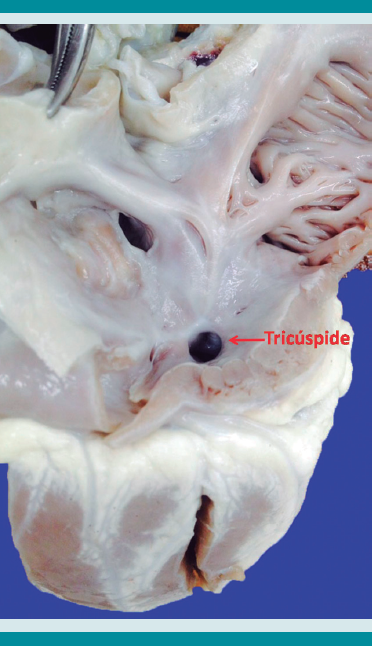  Aurícula derecha dilatada con foramen oval restrictivo (CIA). La tricúspide es displásica con fusión de valvas, un orificio valvular pequeño conduce a un ventrículo derecho hipoplásico.