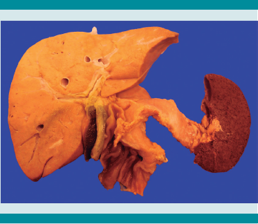 Bloque de hígado, páncreas y bazo. El bazo
es de aspecto séptico, hemorrágico y friable.