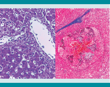 Hepatitis séptica con células inflamatorias
en la pared de venas centrales y suprahepáticas (izquierda).
Esplenitis séptica con hiperemia masiva y colapso
de folículos linfoides (derecha). 

 