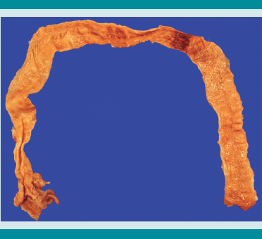 Colon. Colitis isquémica en segmento hemorrágico en ángulo
esplénico.