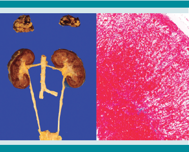 Riñones y adrenales. Hemorragia adrenal masiva bilateral y necrosis cortical renal (izquierda). Aspecto microscópico de la hemorragia masiva adrenal (derecha).