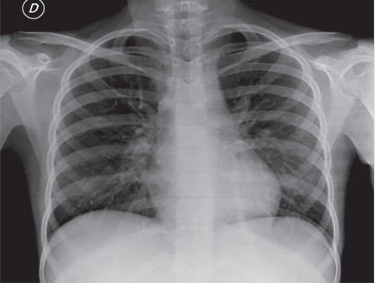Radiograf&iacute;a de t&oacute;rax.
