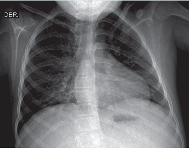 Radiograf&iacute;a de t&oacute;rax.