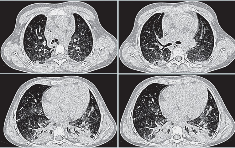 Tomograf&iacute;a computada de alta resoluci&oacute;n pulmonar.