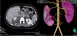 AngioTac abdómino-pélvico: hematoma retroperitoneal derecho sin signos de
                        sangrado activo. Malformación de la vasculatura renal.