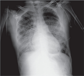Radiografía de tórax tras suspender la transfusión: opacidades pulmonares
                        bilaterales y difusas sin cardiomegalia.