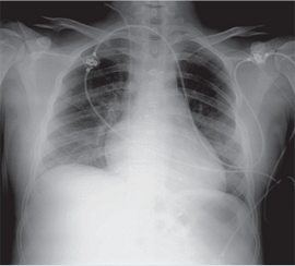 Radiografía de tórax tras extubación al cuarto día de ingreso en la
                        UCIP.