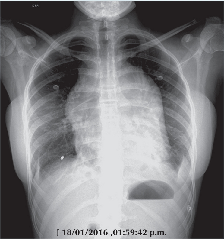 Estudio radiogr&aacute;fico de tele de t&oacute;rax donde se demuestra crecimiento
                        mediastinal a expensas de mediastino medio y anterior, as&iacute; como crecimiento
                        bilateral de gl&aacute;ndulas mamarias.
