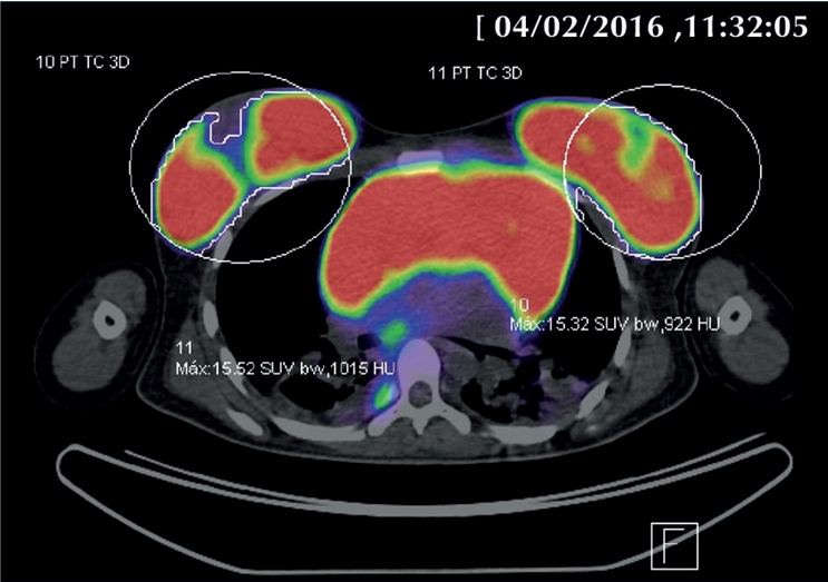 Estudio de PET CT con 18FDG con intensa captaci&oacute;n del radiotrazador en
                        mediastino y mamas con SUVmax de hasta 16.
