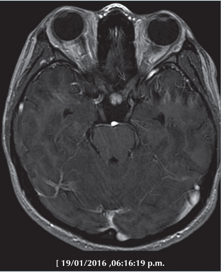 Imagen de resonancia magn&eacute;tica en secuencia SPGR, ponderada en T1
                        contrastada con gadolinio demostr&aacute;ndose el engrosamiento y reforzamiento de
                        los nervios craneales (2&ordm; y 3&ordm; en esta imagen).