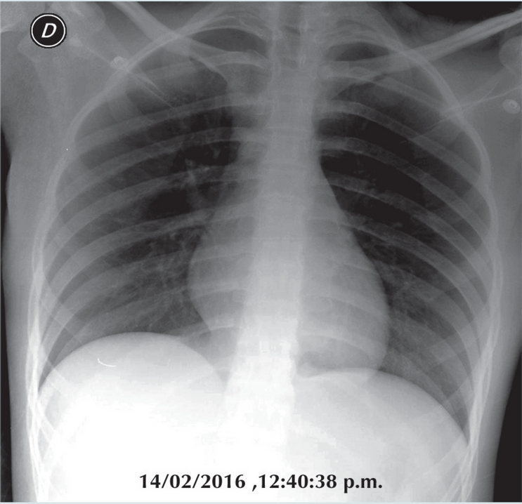 A casi un mes se demuestra resoluci&oacute;n pr&aacute;cticamente total de los
                        crecimientos mediastinales as&iacute; como de la mama con un estudio de tele de
                        t&oacute;rax normal.