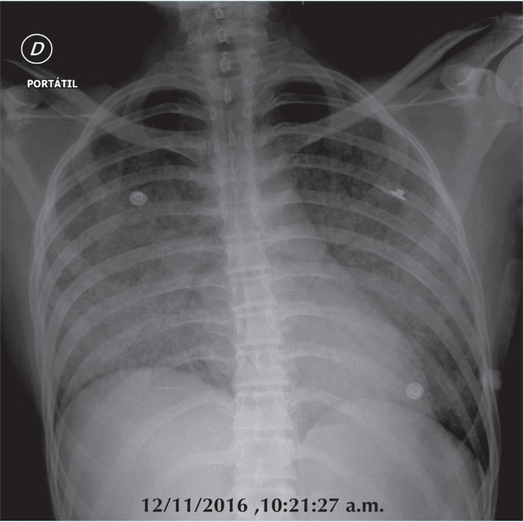Estudio radiogr&aacute;fico de t&oacute;rax port&aacute;til demostr&aacute;ndose radio opacidad
                        pulmonar con un patr&oacute;n ret&iacute;culo nodular denso, bilateral y sim&eacute;trico con
                        presencia de broncograma a&eacute;reo