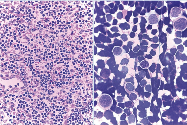 Linfoma mediastinal. Biopsia de mediastino (izquierda) que muestra el
                        tumor formado por c&eacute;lulas linfoides de aspecto bl&aacute;stico. L&iacute;quido
                        cefalorraqu&iacute;deo (derecha) con numerosos blastos linfodies sobre un fondo de
                        eritrocitos.