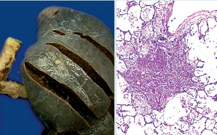 En los pulmones (izquierda) hay numerosas granulaciones subpleurales y
                        parenquimatosas. Al examen microsc&oacute;pico (derecha) se aprecian focos de
                        necrosis, con componentes de da&ntilde;o alveolar agudo, rodeados de alveolos bien
                        ventilados.