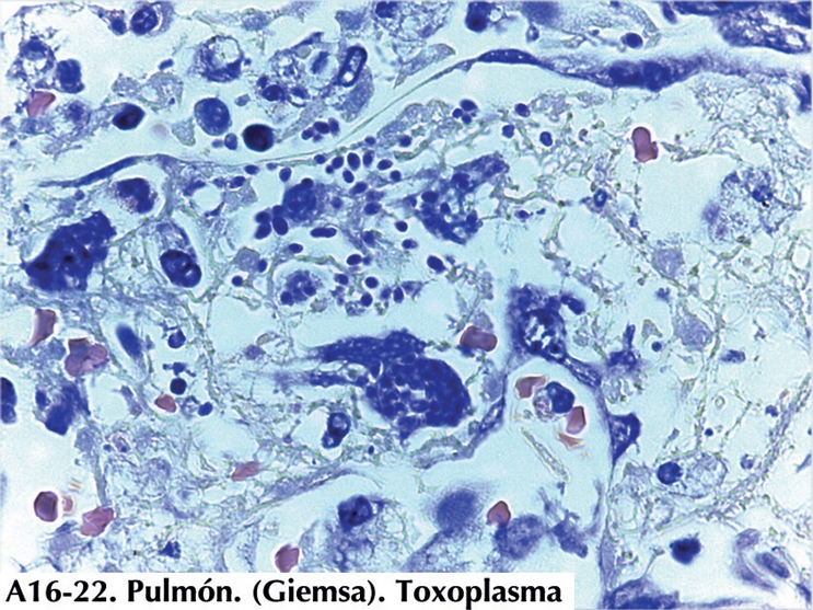 En los focos de necrosis en pulm&oacute;n hay numerosos taquizoitos de
                            Toxoplasma tanto dentro de pseudoquistes como dispersos
                        en la necrosis. (Giemsa).