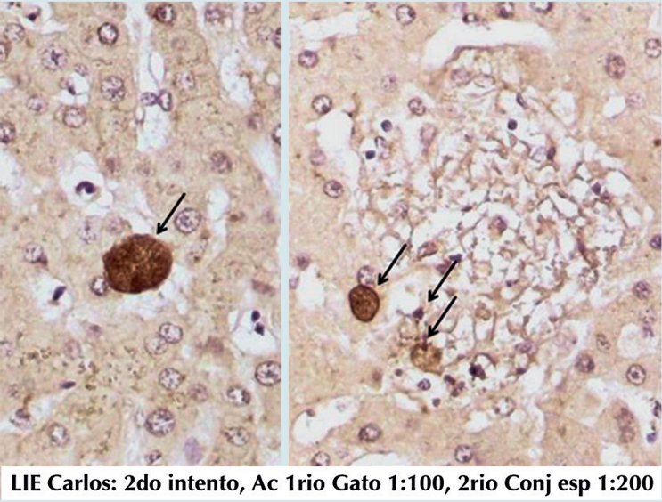 La inmunohistoqu&iacute;mica con anticuerpo espec&iacute;fico anti
                            Toxoplasma revela la presencia de pseudoquistes, en
                        este caso en los focos de necrosis en h&iacute;gado (Cortes&iacute;a Dr. Carlos
                        Cedillo).