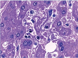 En un foco de necrosis en h&iacute;gado se identifica un pseudoquiste de con
                        taquizoitos (arriba en medio) y macr&oacute;fagos con restos celulares
                        fagocitados.