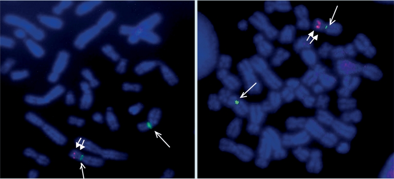 An&aacute;lisis de FISH para la detecci&oacute;n de una microdeleci&oacute;n 7p15.
                            An&aacute;lisis de una metafase con las sondas&nbsp; alfa sat&eacute;lite (una flecha
                            delgada), para la localizaci&oacute;n del centr&oacute;mero del cromosoma 7 (D7Z1)
                            marcada con fluorocromo verde (Q-BIOgene) y sonda locus espec&iacute;fica (dos
                            flechas gruesas) para la detecci&oacute;n de la regi&oacute;n 7p15.2 en donde se
                            localizan los genes HOXA6-HOXA13 marcada con fluorocromo rojo (SureFiSH,
                            Agilent).