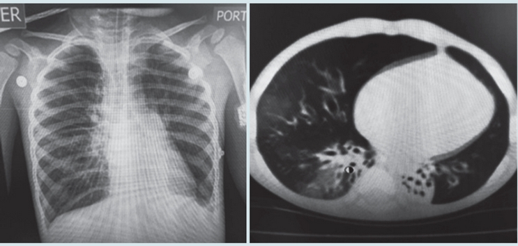 Caso 6: Radiograf&iacute;a de t&oacute;rax con importante atrapamiento de aire y tomograf&iacute;a con patr&oacute;n en mosaico y bronquiectasias, hallazgos caracter&iacute;sticos de la bronquiolitis obliterante post-infecciosa.