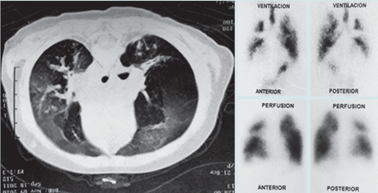 Caso 9: Tomograf&iacute;a de t&oacute;rax y gammagraf&iacute;a de ventilaci&oacute;n-perfusi&oacute;n con cambios caracter&iacute;sticos de bronquiolitis obliterante post-infecciosa: patr&oacute;n en mosaico y defectos multifocales de ventilaci&oacute;n y perfusi&oacute;n.