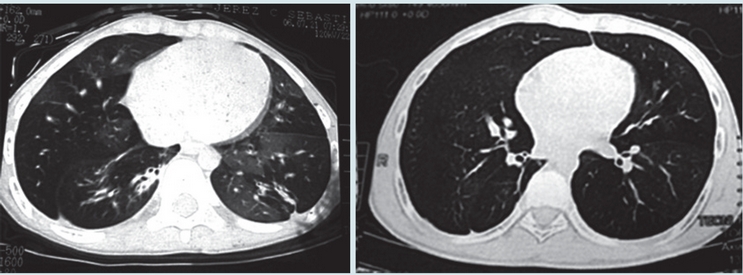 Caso 7: evoluci&oacute;n de la tomograf&iacute;a despu&eacute;s de 8 a&ntilde;os con marcada mejor&iacute;a.