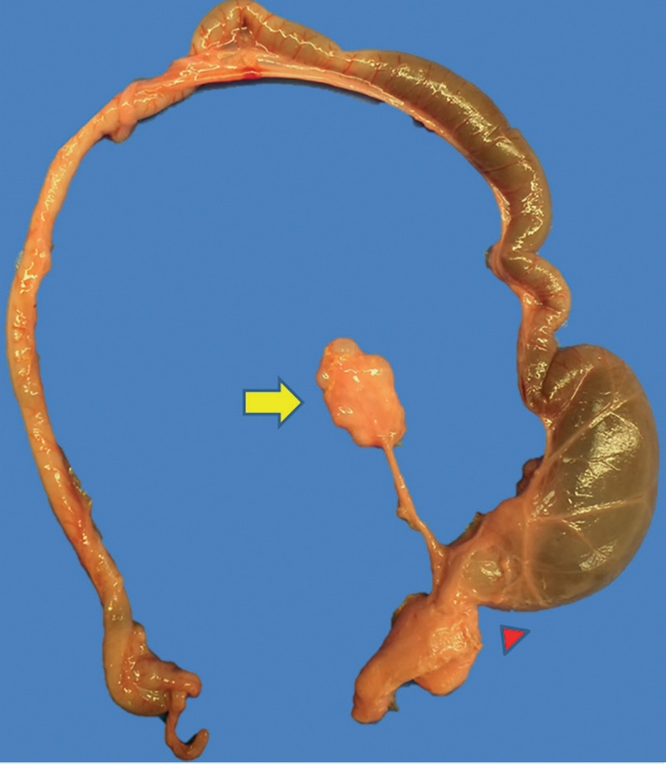 Foto macrosc&oacute;pica que muestra segmento de colon descendente dilatado, con f&iacute;stula hacia vejiga (punta de flecha roja). Tambi&eacute;n se observa ri&ntilde;&oacute;n de lado izquierdo disminuido de tama&ntilde;o (1.1 vs. 17 g) y de aspecto multiqu&iacute;stico.