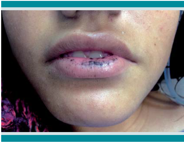 Lesiones hipercrómicas características del síndrome de Peutz-Jeghers.