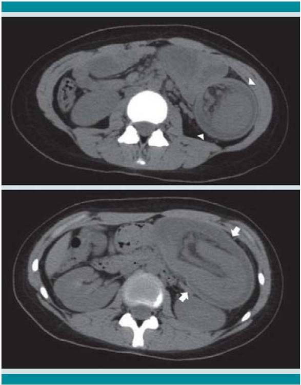 En la parte superior se observa una imagen clásica del signo de la rosquilla (punta de flecha). La imagen inferior se caracteriza por bandas de diferente densidad en relación con las paredes del asa del intestino que se introduce dentro de su propia luz (flechas).