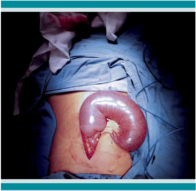 Laparotomía exploradora donde se observa la invaginación intestinal sin datos de sufrimiento.