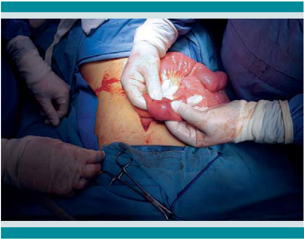 Pólipo intraluminal identificado por palpación a 15 cm del ligamento de Treitz.