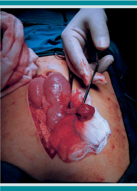 Pólipo pediculado identificado por enterotomía transoperatoria.