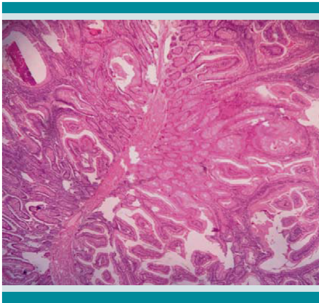 Histología de pólipo hamartomatoso. Se observa crecimiento aberrante de tejido normal con fibras de músculo liso en apariencia circunvolucionada. Mucosa intestinal con epitelio columnar absortivo, células de Paneth, argentafines y caliciformes. Sin displasia.